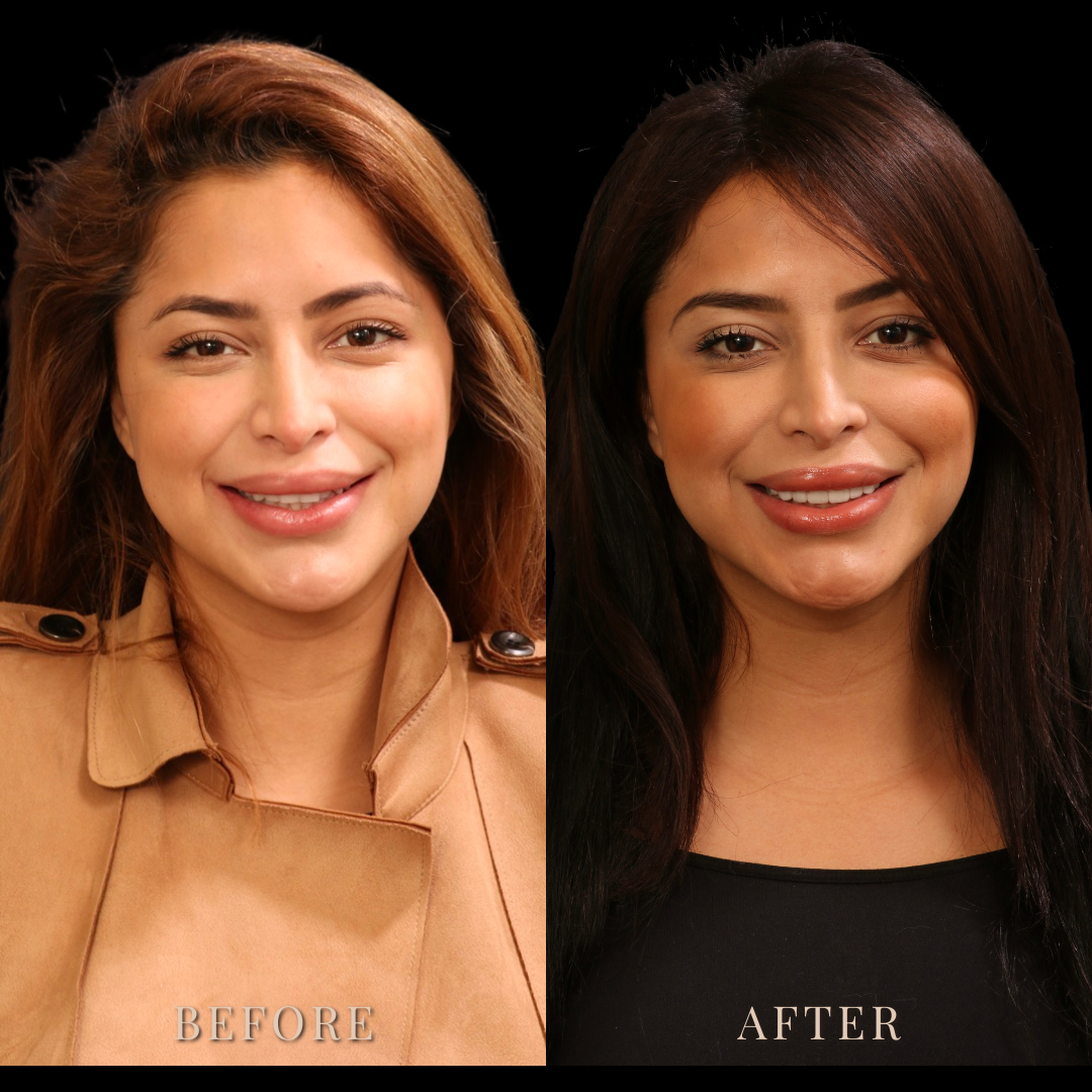 Smile Transformations | The Houston Dentists
